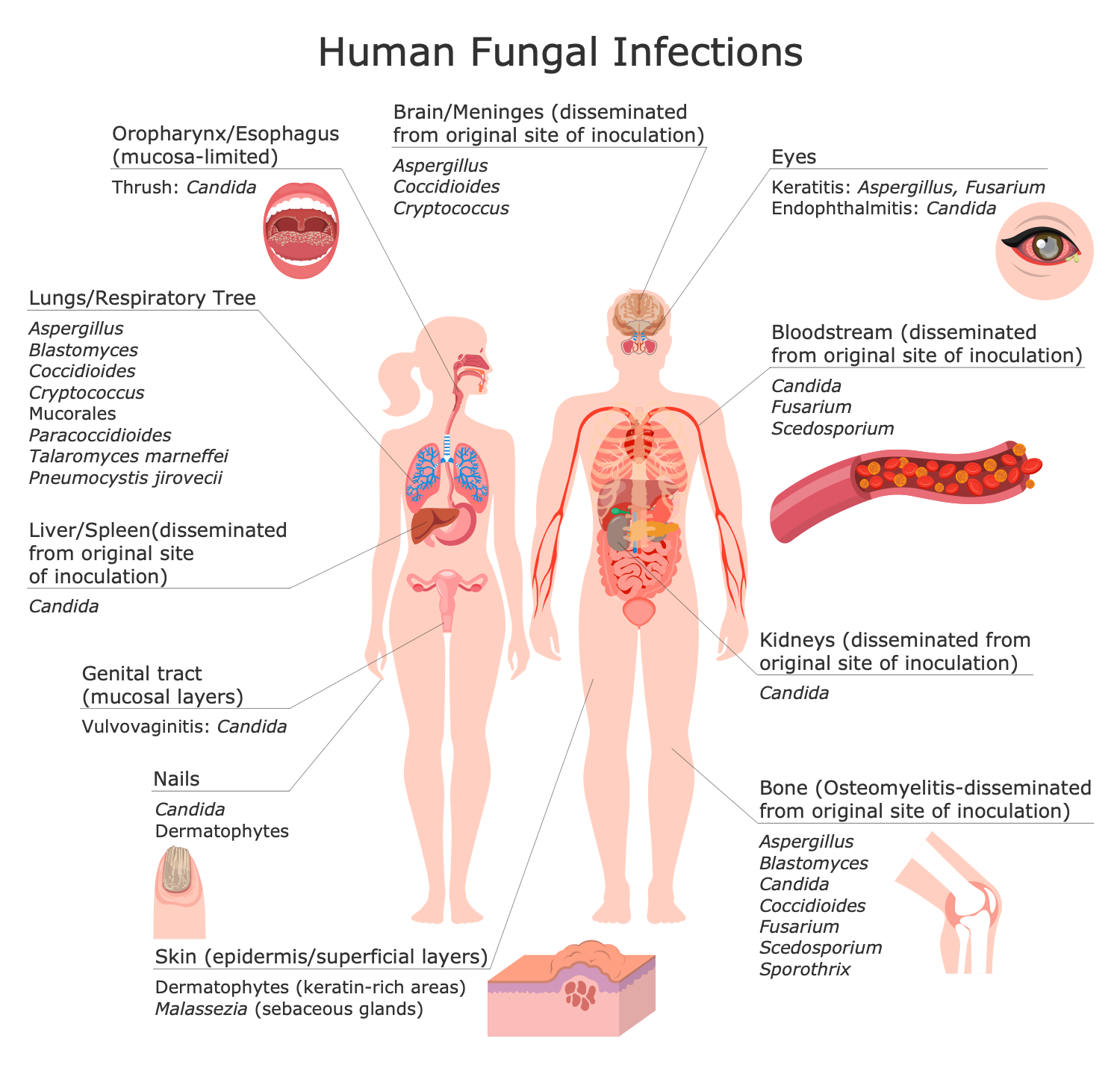 Fungal Diseases - Fungal Meningitis