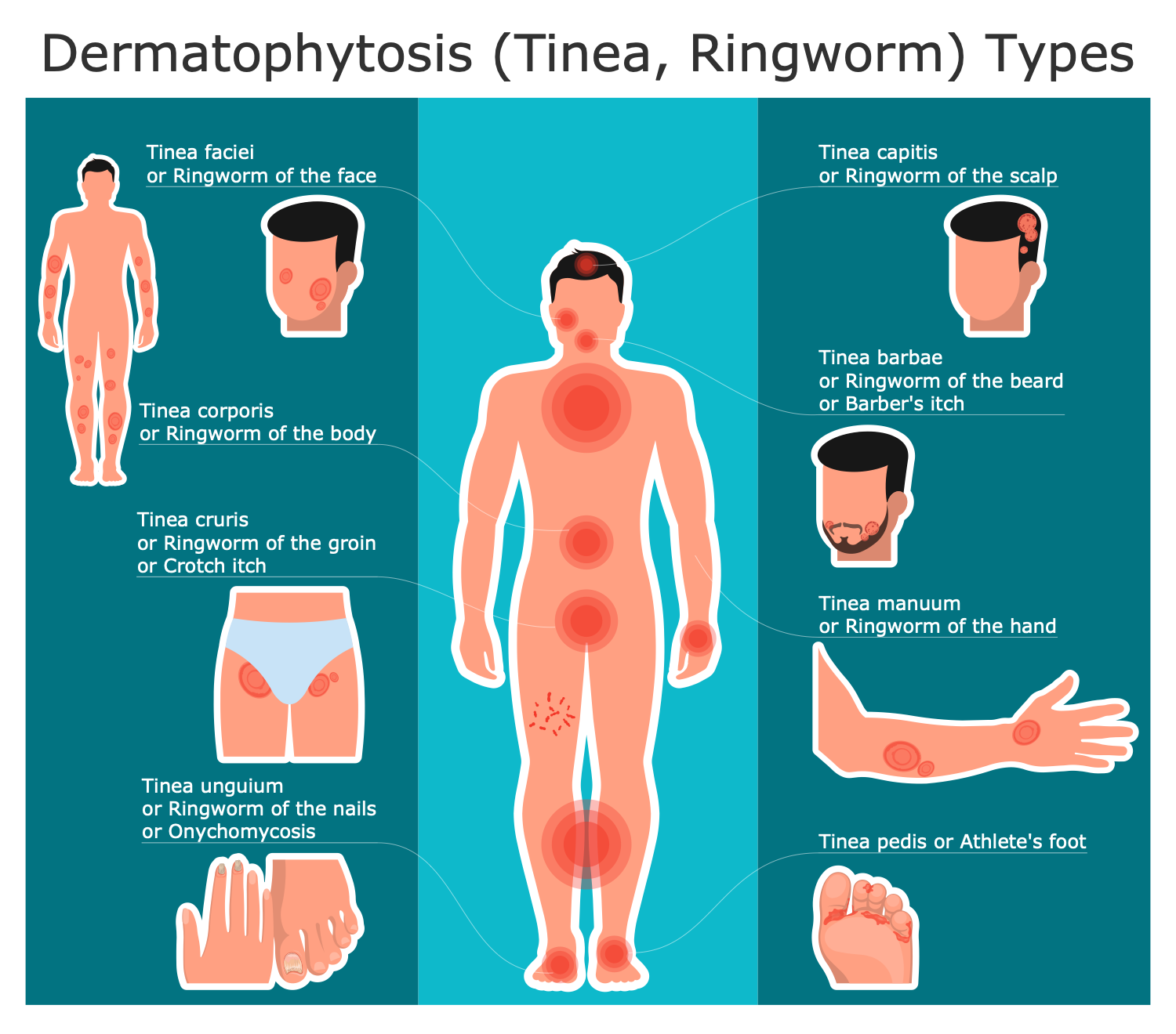 Dermatophytosis Types