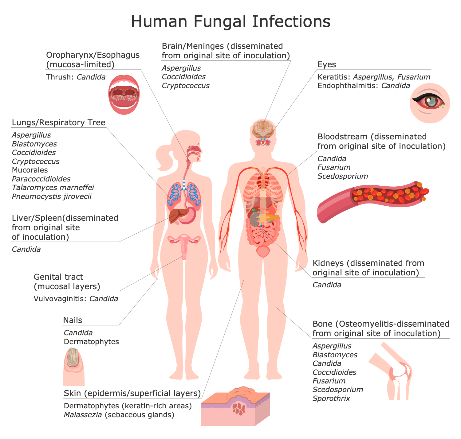 Human Fungal Diseases
